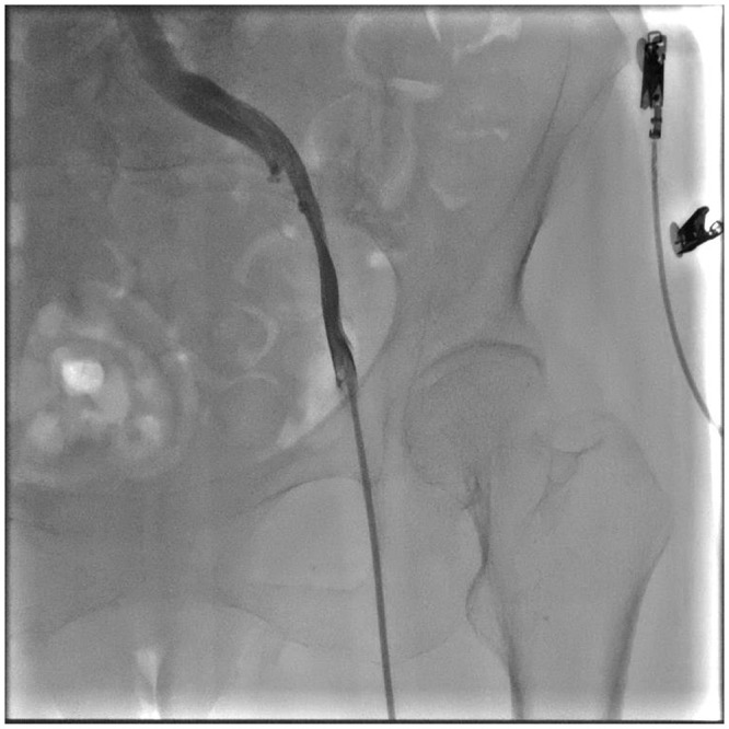 Right Internal Jugular Vein Access for Micra Leadless Pacemaker Implantation in a High-Risk Patient with Severe Iliac Vein Stenosis: A Case Report.