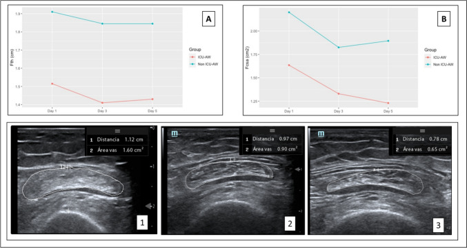 Prospective ultrasonographic evaluation of femoral and vastus intermedius muscles as predictors of ICU-acquired weakness in critically ill patients.