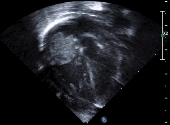 Infective atrial thrombus.