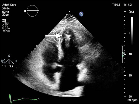 Accidental Left Ventricular Placement of a Leadless Micra Pacemaker Through a Patent Foramen Ovale.