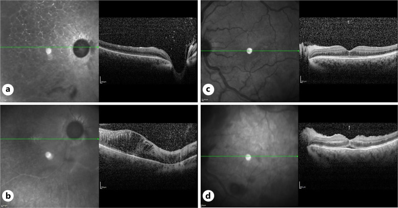 Neovascular Proliferation over a Cosmetic Artificial Iris Implant.