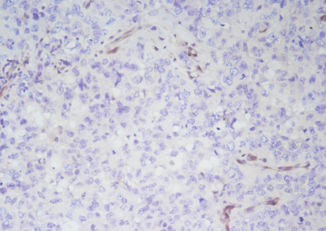 Prognostic Importance of PTEN and P53 in Aggressive Luminal A Subtype Breast Cancers.