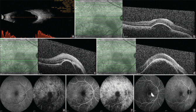 Central serous chorioretinopathy mimicking as choroidal hemangioma - A diagnostic challenge.