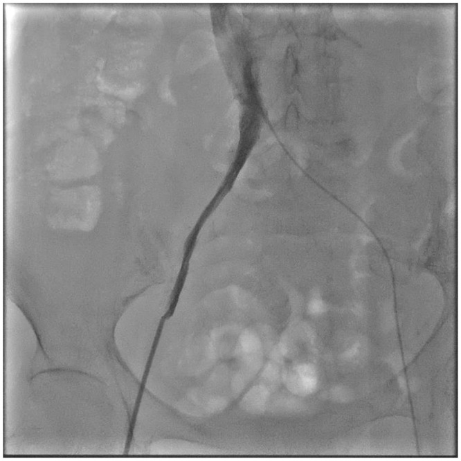 Right Internal Jugular Vein Access for Micra Leadless Pacemaker Implantation in a High-Risk Patient with Severe Iliac Vein Stenosis: A Case Report.
