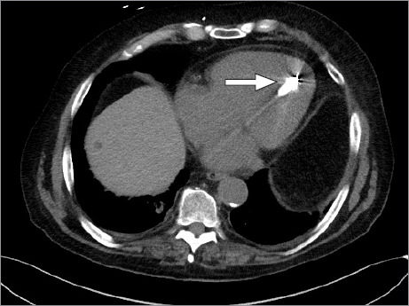 Accidental Left Ventricular Placement of a Leadless Micra Pacemaker Through a Patent Foramen Ovale.