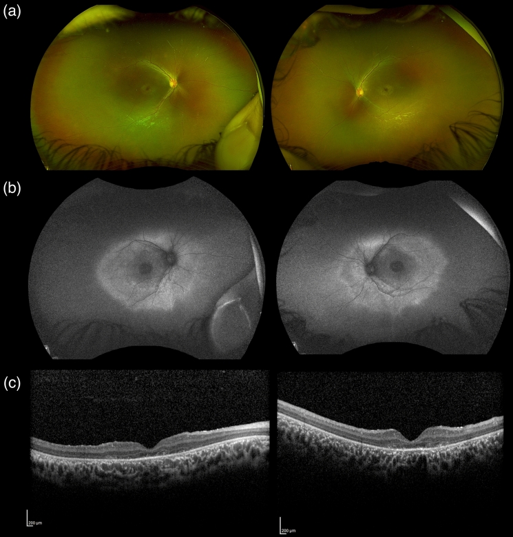 A novel mutation in CNNM4 is associated with a case of Jalili syndrome in Egypt.