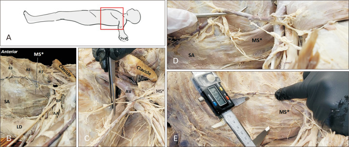 A constellation of anatomical variation: middle scalene, wrist extensor, and aortic arch variants share embryological origins in cervical somites.