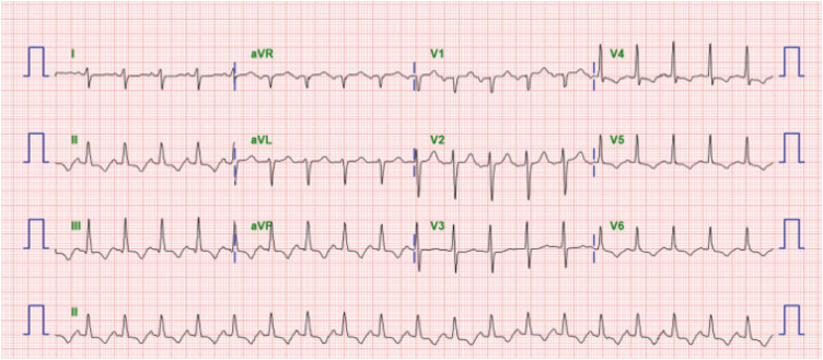 CMR Parametric Mapping Helps Diagnose Diffuse Myocardial Leukemic Infiltration in the Relapse of Acute Lymphoblastic Leukemia.