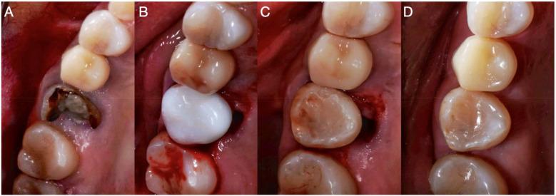 Case Report: Dental autotransplantation for the resolution of odontogenic sinusitis using 3D replication.