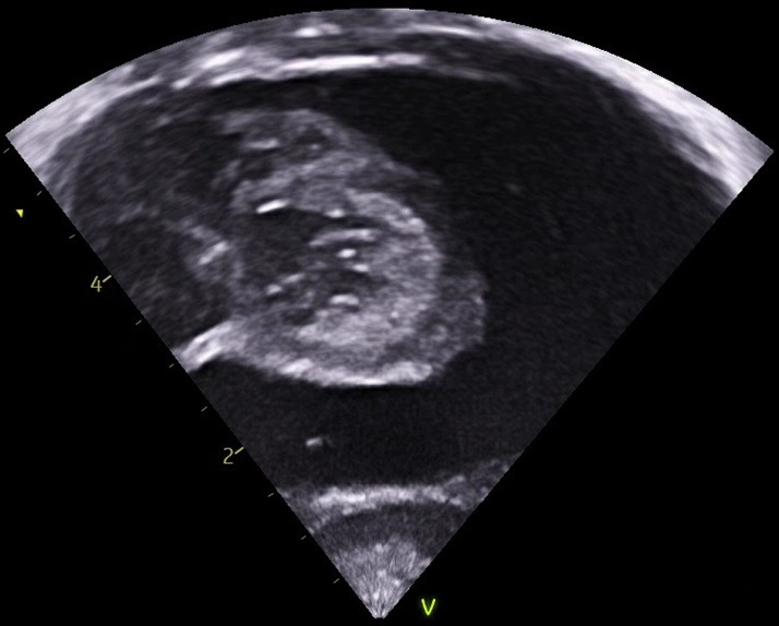 Infective atrial thrombus.