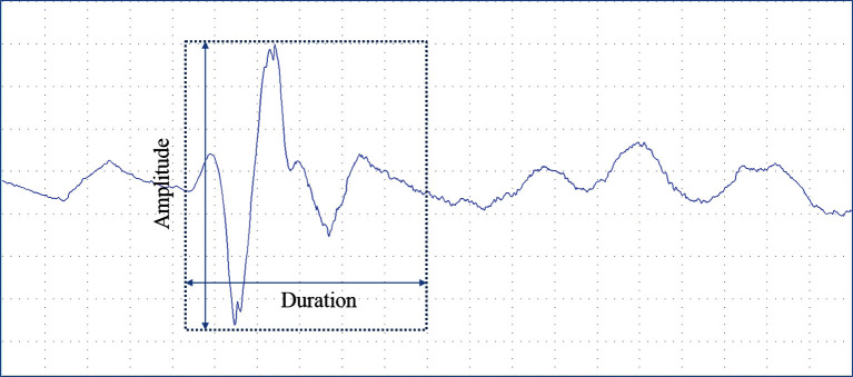 Clinical value of spontaneous cavernous activity evaluation in identifying misdiagnosed corporal venous occlusive dysfunction in psychogenic erectile dysfunction.