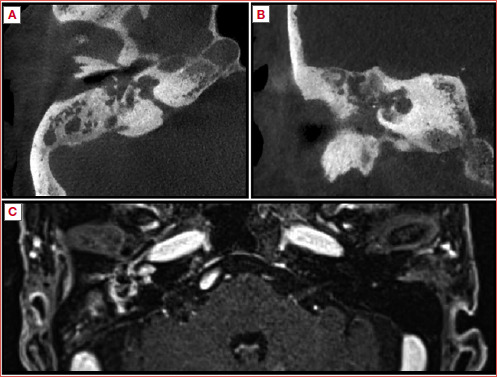 Granulomatosis with polyangiitis presenting as isolated ear involvement: a case series and literature review.