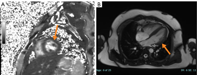 IgG4 elevation dilemma at the crossroads of helminth infection and IgG4-related disease: insights from a case report of pediatric paragonimiasis with persistent pericardial effusion.