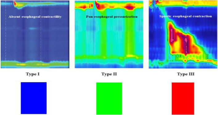 The Reverse Red-Green-Blue Rule: A Color-Coded Approach for Simplified Achalasia Diagnosis via High-Resolution Manometry.