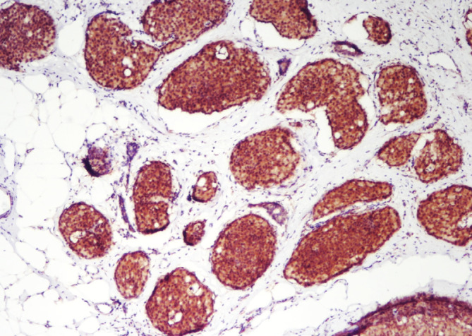 Prognostic Importance of PTEN and P53 in Aggressive Luminal A Subtype Breast Cancers.