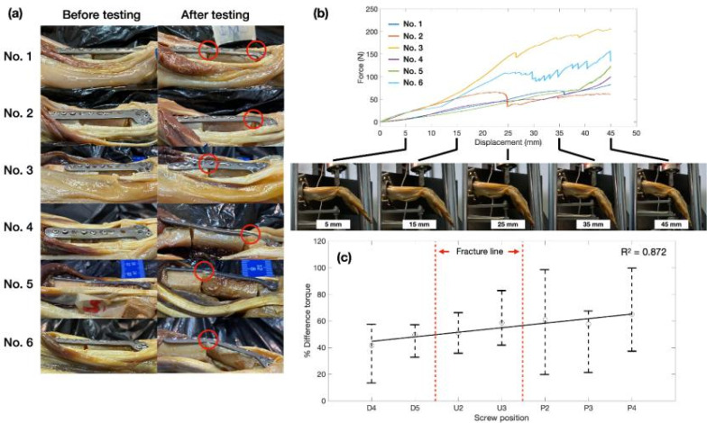 Evaluation of screw pull-out from plate fixation of en bloc distal radius resection with ulnar reconstruction: Finite element analysis and comparison with experiments on Thiel cadavers.