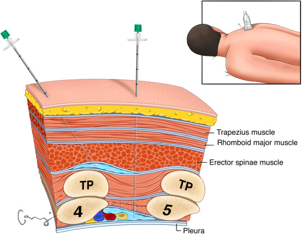 Pain Management in Minimally Invasive Cardiac Surgery: A Review of Current Clinical Evidence.