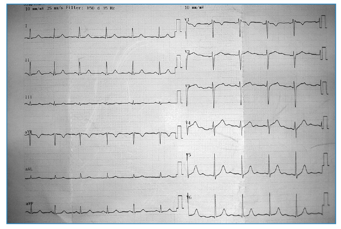 Crimean-Congo hemorrhagic fever with severe bradycardia treated with Theophylline.