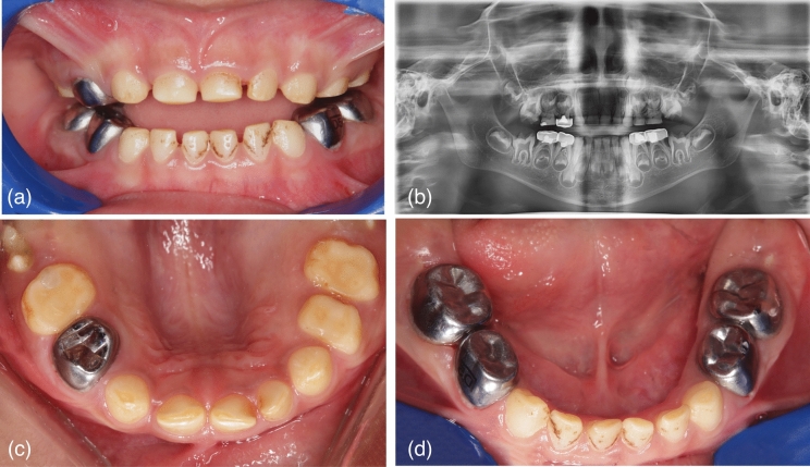 A novel mutation in CNNM4 is associated with a case of Jalili syndrome in Egypt.