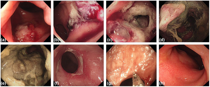 Successful sphincter preservation and long-term survival in a patient with ultra-low locally advanced rectal cancer treated with photodynamic therapy combined with multimodal treatment: a case report and literature review.
