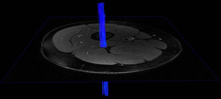 Intradermal Advanced Glycation End-products Relate to Reduced Sciatic Nerve Structural Integrity in Type 2 Diabetes.