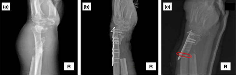 Evaluation of screw pull-out from plate fixation of en bloc distal radius resection with ulnar reconstruction: Finite element analysis and comparison with experiments on Thiel cadavers.