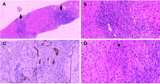 Atorvastatin unveiling primary biliary cholangitis and autoimmune hepatitis overlap syndrome in an older adult: A case report.