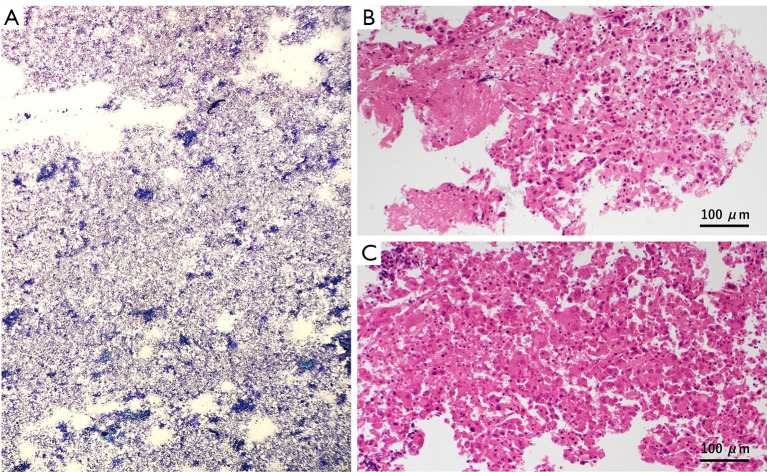 Needle tract seeding after endobronchial ultrasound-guided intranodal forceps biopsy and cryobiopsy: a case report.