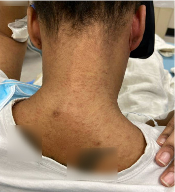 Drug Reaction With Eosinophilia and Systemic Symptoms (DRESS) Syndrome Following Initiation of Sulfasalazine for Ulcerative Colitis: A Yearlong Clinical Challenge.