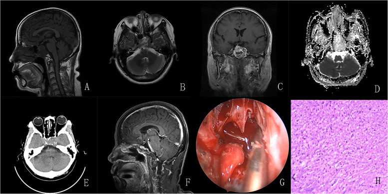 EEA for sellar chodrosarcomas: case series with literature review.
