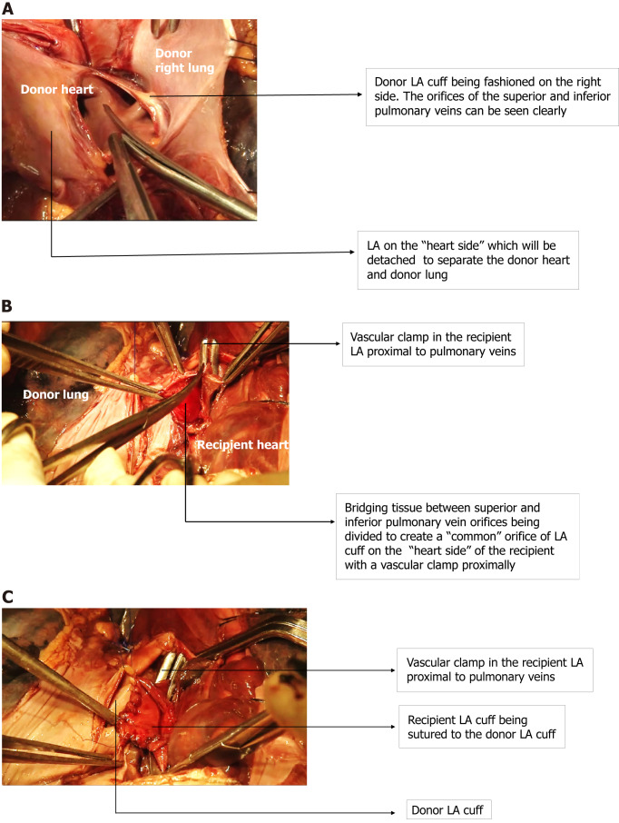 Atrial arrhythmias following lung transplantation: A state of the art review.