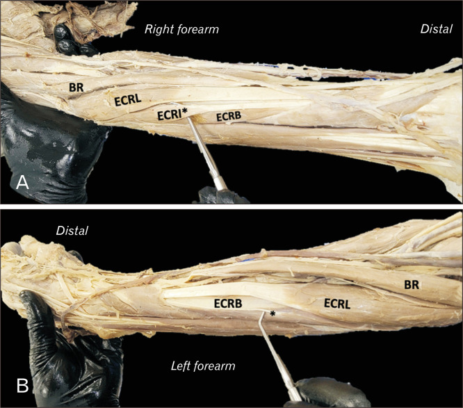 A constellation of anatomical variation: middle scalene, wrist extensor, and aortic arch variants share embryological origins in cervical somites.