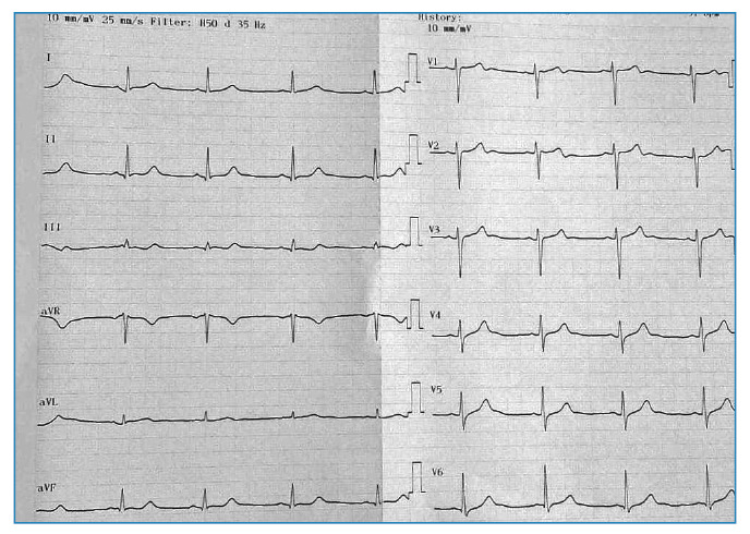 Crimean-Congo hemorrhagic fever with severe bradycardia treated with Theophylline.