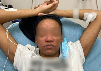 Drug Reaction With Eosinophilia and Systemic Symptoms (DRESS) Syndrome Following Initiation of Sulfasalazine for Ulcerative Colitis: A Yearlong Clinical Challenge.