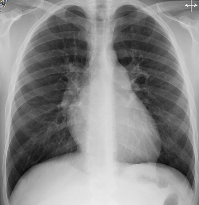 An unprecedented pathology in a 20-year-old with progressive dyspnoea and parenchymal infiltrates.