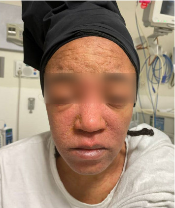 Drug Reaction With Eosinophilia and Systemic Symptoms (DRESS) Syndrome Following Initiation of Sulfasalazine for Ulcerative Colitis: A Yearlong Clinical Challenge.