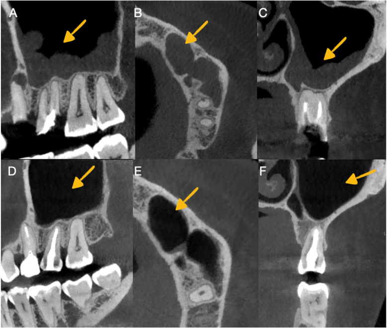 Case Report: Dental autotransplantation for the resolution of odontogenic sinusitis using 3D replication.