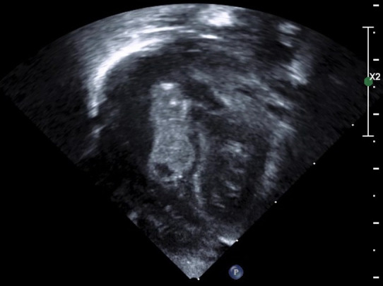 Infective atrial thrombus.