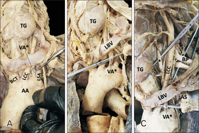 A constellation of anatomical variation: middle scalene, wrist extensor, and aortic arch variants share embryological origins in cervical somites.