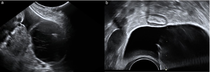 Ultrasound-guided cyst aspiration for management of acute adnexal torsion.