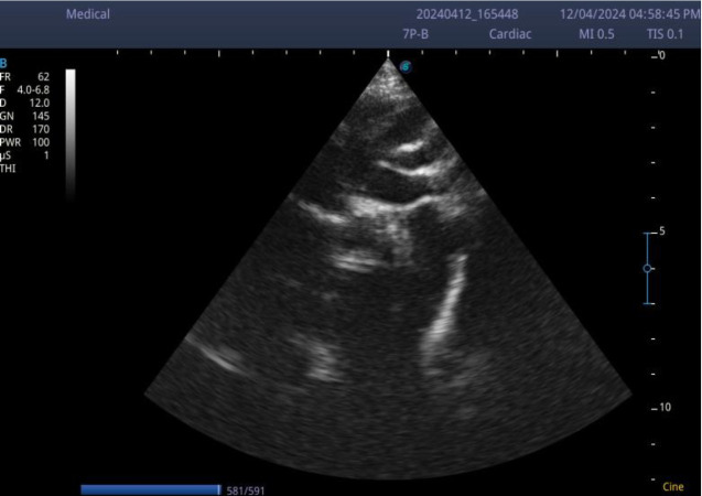 Coarctation of the Aorta Presenting as Haemorrhagic Stroke in a 3-Year-Old Boy- A Case Report.