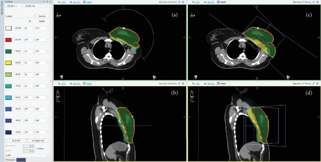 One Week Hypofractionated Adjuvant Radiation for Early Breast Cancer Patients Treated at a Tertiary Cancer Centre in South India: A Comparative Dosimetric Study of Forward Intensity-Modulated Radiotherapy (F-IMRT) and Volumetric Modulated Arc Therapy (VMAT).