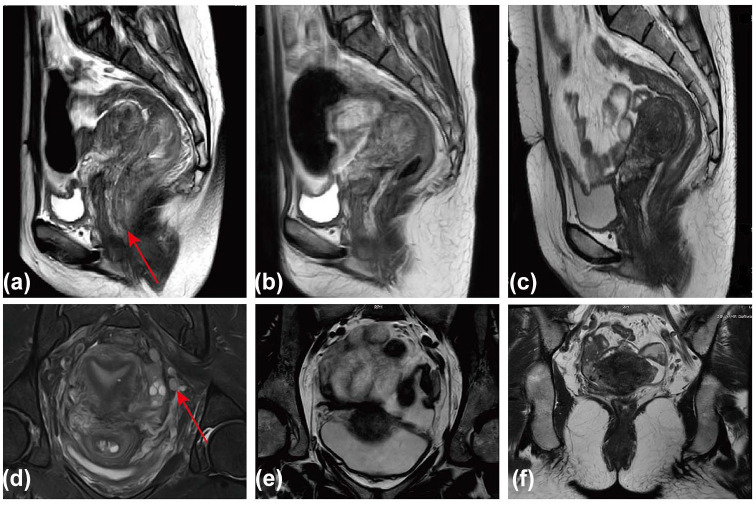 Successful sphincter preservation and long-term survival in a patient with ultra-low locally advanced rectal cancer treated with photodynamic therapy combined with multimodal treatment: a case report and literature review.