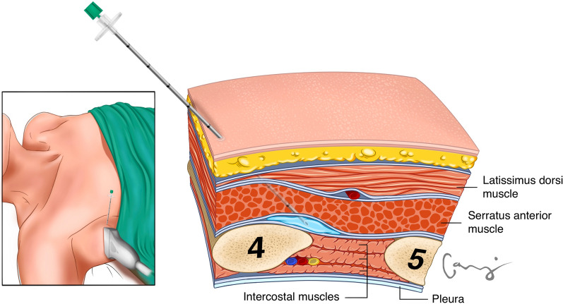 Pain Management in Minimally Invasive Cardiac Surgery: A Review of Current Clinical Evidence.