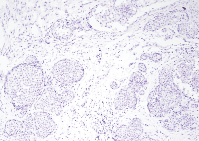 Prognostic Importance of PTEN and P53 in Aggressive Luminal A Subtype Breast Cancers.