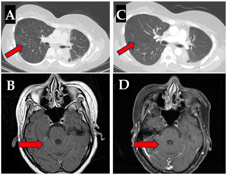 Osimertinib-Induced Hepatitis Following Immunotherapy in a Patient with Lung Adenocarcinoma Harboring De Novo EGFR Exon 19 Deletion and T790M Mutations: A Case Report.