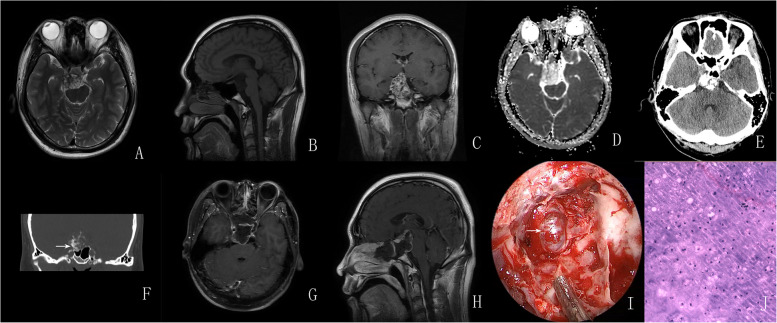 EEA for sellar chodrosarcomas: case series with literature review.