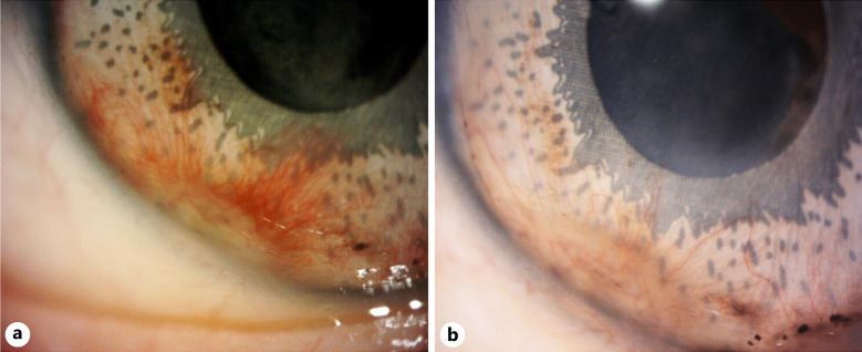 Neovascular Proliferation over a Cosmetic Artificial Iris Implant.