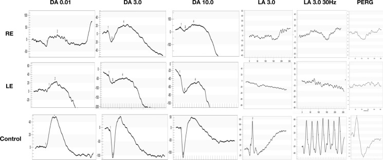 A novel mutation in CNNM4 is associated with a case of Jalili syndrome in Egypt.