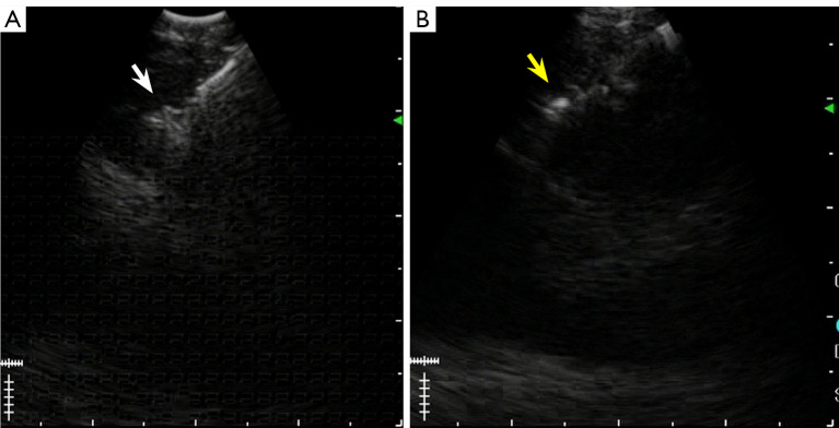Needle tract seeding after endobronchial ultrasound-guided intranodal forceps biopsy and cryobiopsy: a case report.